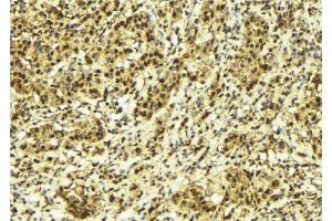 ABIN6273140 at 1/100 staining Human breast cancer tissue by IHC-P. (MLXIP antibody  (N-Term))