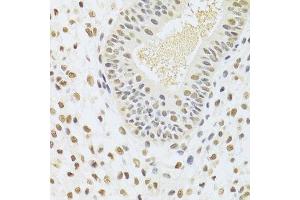 Immunohistochemistry of paraffin-embedded human uterine cancer using DDB1 Antibody. (DDB1 antibody)