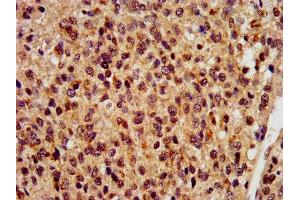 IHC image of ABIN7168275 diluted at 1:400 and staining in paraffin-embedded human glioma performed on a Leica BondTM system. (RBM9 antibody  (AA 8-110))