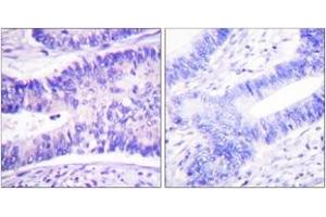 Immunohistochemistry analysis of paraffin-embedded human colon carcinoma, using WAVE1 (Phospho-Tyr125) Antibody.