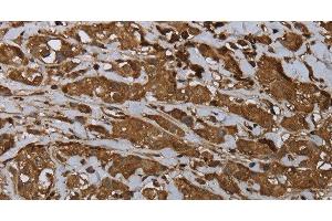 Immunohistochemistry of paraffin-embedded Human breast cancer using ARHGDIA Polyclonal Antibody at dilution of 1:30 (ARHGDIA antibody)