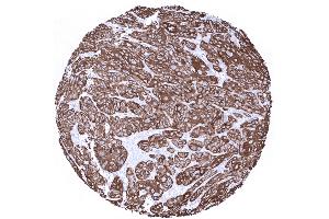 Squamous cell carcinoma of the uterine cervix with strong Cytokeratin 6 positivity (Recombinant Keratin 6 antibody)