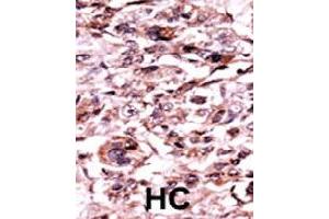 Formalin-fixed and paraffin-embedded human hepatocellular carcinoma tissue reacted with ABL1 (phospho Y245) polyclonal antibody  which was peroxidase-conjugated to the secondary antibody followed by AEC staining.