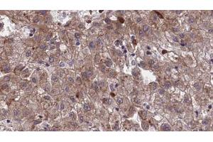 ABIN6273968 at 1/100 staining Human liver cancer tissue by IHC-P. (OR1I1 antibody  (C-Term))