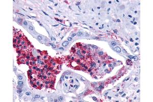 Anti-LTB4R2 / BLT2 antibody IHC of human Pancreas, Carcinoma and Leukocytes.