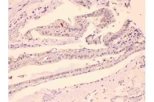 HDGF was detected in paraffin-embedded sections of human intestinal cancer tissues using rabbit anti- HDGF Antigen Affinity purified polyclonal antibody (Catalog # ) at 1 µg/mL. (HDGF antibody  (C-Term))