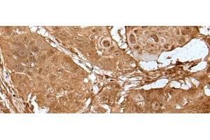 Immunohistochemistry of paraffin-embedded Human esophagus cancer tissue using LIPG Polyclonal Antibody at dilution of 1:50(x200) (LIPG antibody)