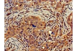 Immunohistochemistry of paraffin-embedded human pancreatic cancer using ABIN7149854 at dilution of 1:100 (DGAT1 antibody  (AA 1-62))