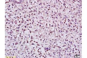 Formalin-fixed and paraffin embedded human gastric carcinoma labeled with Anti Phospho-MLK3(Thr277/Ser281) Polyclonal Antibody, Unconjugated (ABIN743963) at 1:200 followed by conjugation to the secondary antibody and DAB staining