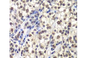 Immunohistochemistry of paraffin-embedded Human kidney cancer using CENPC Polyclonal Antibody at dilution of 1:200 (40x lens). (Centromere Protein C Pseudogene 1 (CENPCP1) antibody)