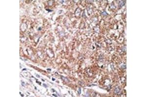 IHC analysis of FFPE human hepatocarcinoma tissue stained with the Nestin antibody (Nestin antibody  (AA 1560-1590))