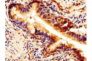 Immunohistochemistry of paraffin-embedded human lung cancer using ABIN7163691 at dilution of 1:100 (Pleiotrophin antibody  (AA 33-168))