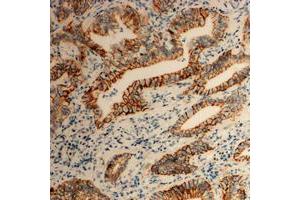 Immunohistochemical analysis of Tetraspanin 8 staining in human colon cancer formalin fixed paraffin embedded tissue section. (Tspan-8 antibody  (Center))