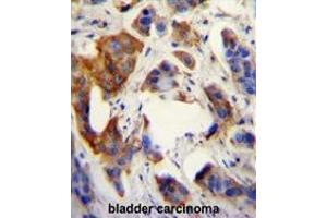 UBFD1 antibody (N-term) immunohistochemistry analysis in formalin fixed and paraffin embedded human bladder carcinoma followed by peroxidase conjugation of the secondary antibody and DAB staining. (UBFD1 antibody  (N-Term))
