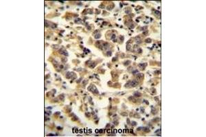 TTC39B antibody (C-term) (ABIN654972 and ABIN2844610) immunohistochemistry analysis in formalin fixed and paraffin embedded human testis carcinoma followed by peroxidase conjugation of the secondary antibody and DAB staining. (TTC39B antibody  (C-Term))
