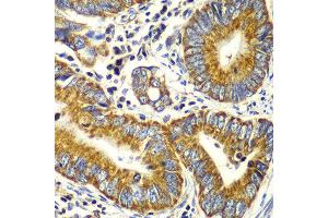 Immunohistochemistry of paraffin-embedded human colon carcinoma using TOMM20 antibody at dilution of 1:100 (x40 lens). (TOMM20 antibody)