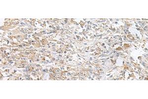 Immunohistochemistry of paraffin-embedded Human liver cancer tissue using PFKM Polyclonal Antibody at dilution of 1:60(x200) (PFKM antibody)