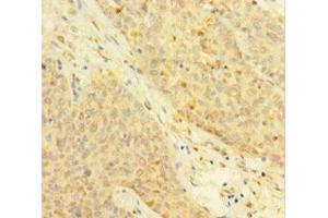 Immunohistochemistry of paraffin-embedded human ovarian cancer using ABIN7172118 at dilution of 1:100 (Thymidine Phosphorylase antibody  (AA 13-254))