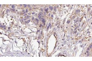 ABIN6273035 at 1/100 staining Human Melanoma tissue by IHC-P.