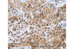 Immunohistochemistry of Human lung cancer using NEB Polyclonal Antibody at dilution of 1:80