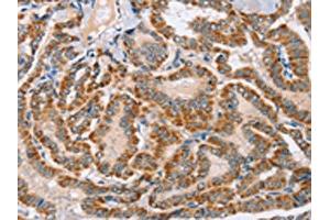 The image on the left is immunohistochemistry of paraffin-embedded Human thyroid cancer tissue using ABIN7130278(MSMB Antibody) at dilution 1/30, on the right is treated with fusion protein. (MSMB antibody)