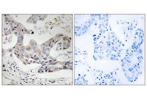 Immunohistochemistry analysis of paraffin-embedded human breast carcinoma tissue, using ALDH3B1 antibody. (ALDH3B1 antibody  (Internal Region))