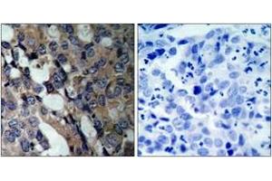 Immunohistochemistry analysis of paraffin-embedded human breast carcinoma tissue, using HSP27 (Ab-15) Antibody. (HSP27 antibody  (AA 5-54))
