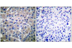 Immunohistochemical analysis of paraffin-embedded human breast carcinoma tissue using p130 Cas (epitope around residue 410) antibody (ABIN5976160). (BCAR1 antibody  (Tyr410))