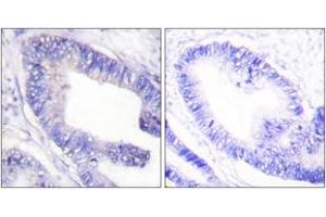 Immunohistochemistry analysis of paraffin-embedded human colon carcinoma, using IRS-1 (Phospho-Ser1101) Antibody. (IRS1 antibody  (pSer1101))