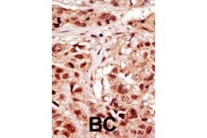 Formalin-fixed and paraffin-embedded human cancer tissue reacted with the primary antibody, which was peroxidase-conjugated to the secondary antibody, followed by DAB staining. (TP53RK antibody  (AA 220-249))