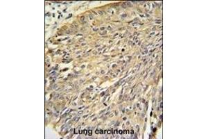 Annexin A1 Antibody (Center) (ABIN390509 and ABIN2840863) IHC analysis in formalin fixed and paraffin embedded human lung carcinoma followed by peroxidase conjugation of the secondary antibody and DAB staining. (Annexin a1 antibody  (AA 129-158))