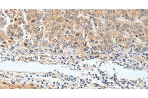 Immunohistochemistry of paraffin-embedded Human lung cancer tissue using BPIFB2 Polyclonal Antibody at dilution 1:45 (BPIL1 antibody)