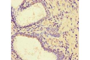 Immunohistochemistry of paraffin-embedded human prostate cancer using ABIN7162730 at dilution of 1:100 (PDLIM5 antibody  (AA 268-404))
