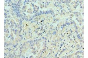 Immunohistochemistry of paraffin-embedded human lung cancer using ABIN7155474 at dilution of 1:100 (EZH1 antibody  (AA 160-280))