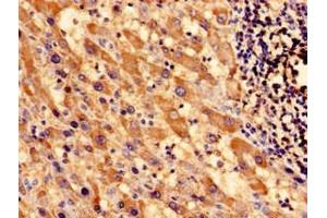Immunocytochemistry analysis of human liver cancer using ABIN7171000 at dilution of 1:100 (SOCS3 antibody  (AA 1-224))