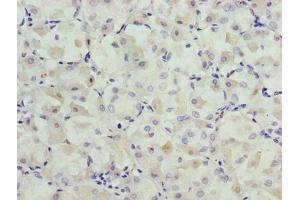 Immunohistochemistry of paraffin-embedded human gastric cancer using ABIN7164554 at dilution of 1:100 (SLC31A2 antibody  (AA 44-93))