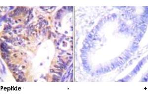 Immunohistochemical analysis of paraffin-embedded human colon carcinoma tissue using PAK1 polyclonal antibody .