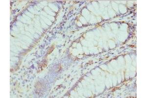Immunohistochemistry of paraffin-embedded human colon cancer using ABIN7174682 at dilution of 1:100 (Cytidine Monophosphate (UMP-CMP) Kinase 1, Cytosolic (CMPK1) (AA 37-196) antibody)