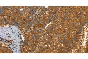 Immunohistochemistry of paraffin-embedded Human liver cancer tissue using PFKFB1 Polyclonal Antibody at dilution 1:60 (PFKFB1 antibody)