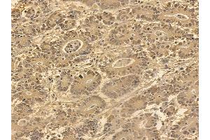 FOXO4 Mouse Monoclonal Antibody at 1/100 staining human colorectal cancer by IHC-P.