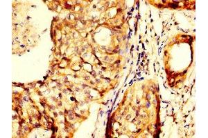 IHC image of ABIN7144013 diluted at 1:300 and staining in paraffin-embedded human cervical cancer performed on a Leica BondTM system. (RHCG antibody  (AA 416-479))