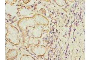 Immunohistochemistry of paraffin-embedded human gastric cancer using ABIN7172732 at dilution of 1:100 (MTERFD1 antibody  (AA 69-300))