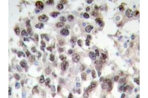 Immunohistochemistry analyzes of PDCD4 antibody in paraffin-embedded human breast carcinoma tissue. (PDCD4 antibody)