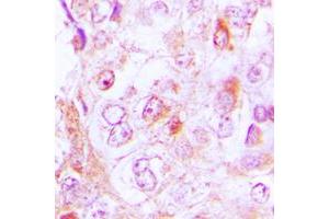 Immunohistochemical analysis of Collagen 6 alpha 2 staining in human lung cancer formalin fixed paraffin embedded tissue section. (COL6A2 antibody  (Center))