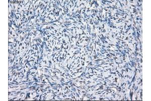 Immunohistochemical staining of paraffin-embedded Adenocarcinoma of breast tissue using anti-SLC7A8 mouse monoclonal antibody. (SLC7A8 antibody)