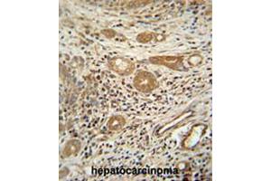 CTSA antibody (N-term) immunohistochemistry analysis in formalin fixed and paraffin embedded human hepatocarcinoma followed by peroxidase conjugation of the secondary antibody and DAB staining. (CTSA antibody  (N-Term))