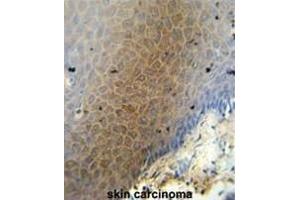 CEP70 antibody (Center) immunohistochemistry analysis in formalin fixed and paraffin embedded human skin carcinoma followed by peroxidase conjugation of the secondary antibody and DAB staining. (CEP70 antibody  (Middle Region))