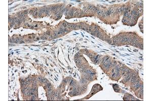 Immunohistochemical staining of paraffin-embedded Adenocarcinoma of Human colon tissue using anti-KHK mouse monoclonal antibody. (Ketohexokinase antibody)