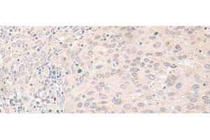 Immunohistochemistry of paraffin-embedded Human cervical cancer tissue using FOXRED2 Polyclonal Antibody at dilution of 1:35(x200) (FOXRED2 antibody)