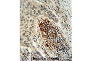 MFAP4 Antibody IHC analysis in formalin fixed and paraffin embedded human lung carcinoma followed by peroxidase conjugation of the secondary antibody and DAB staining. (MFAP4 antibody  (C-Term))